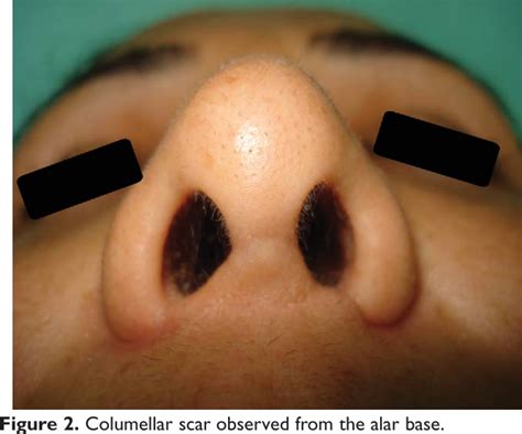 Figure 1 from Effect of Nose Skin on the Columellar Incision Scar in a Turkish Population ...