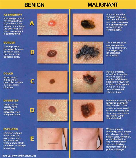 abcdes  skin cancer detection