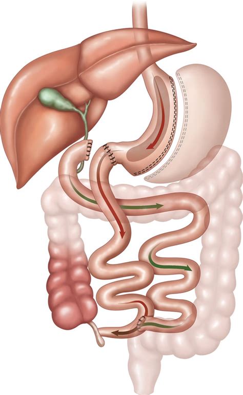 Bariatric surgery: a best practice article | Journal of Clinical Pathology