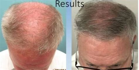 Exosome Hair Loss Therapy | Hartford, CT
