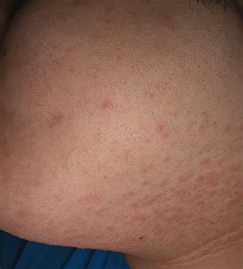 Warum kriege ich einen Ausschlag nach dem Rasieren? (Männer, Körper, Haut)