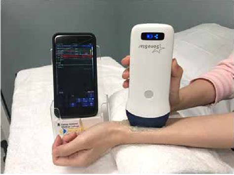 Handheld ultrasound unit is depicted (Sonostar Technologies Co., Ltd ...