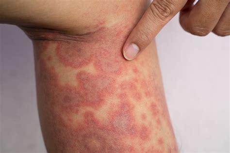 Preventing Flares and Eczema Spread