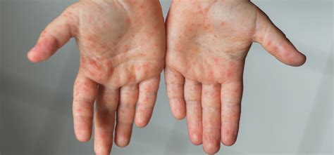 Hand, Foot and Mouth Disease - Le Bonheur Children's Hospital