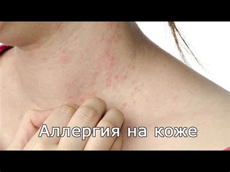 Аллергия на коже - красные пятна чешутся, лечение (фото)