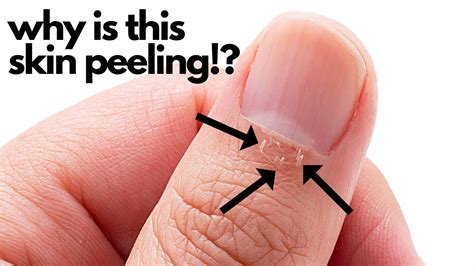cuticle fingernail problems  laura strong blog