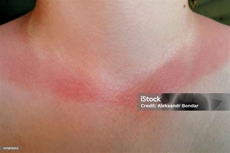 Efeitos Da Cor Vermelha No Ser Humano - Foto de Queimadura Vermelha Do Sol No Pescoço De Uma Mulher Os Efeitos ...