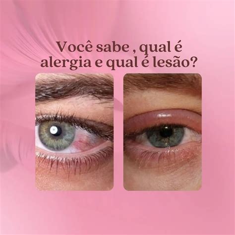saude ocular muitas nao sabem  diferenca entre alergia irritacao ou