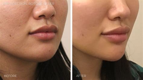 Neck Lift Alternatives: Surgical & Non-surgical Options | Omaha ...