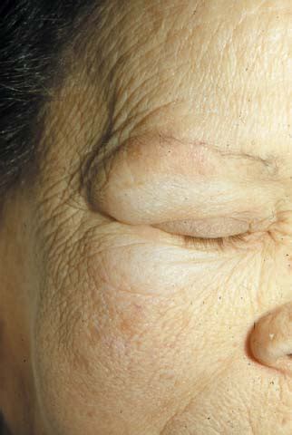 Periorbital Edema Hypothyroidism