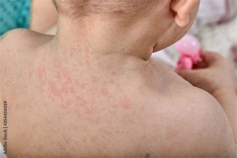 roseola rash  viral rash   skin   child stock photo adobe stock