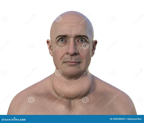 Endemic Goiter, 3D Illustration And Light Micrograph | CartoonDealer ...