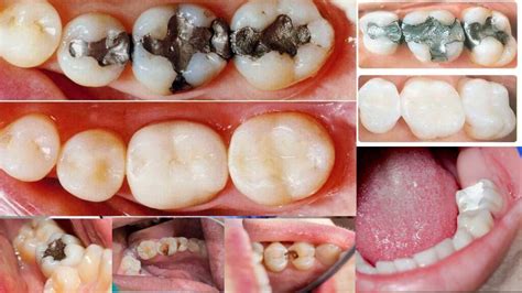 The Different Types of Dental Fillings Explained - Dental Health