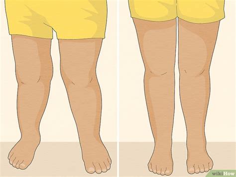 How to Fix Knock Knees: 12 At-Home Methods