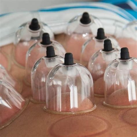 Cupping Therapy Before and After: What You Need to Know