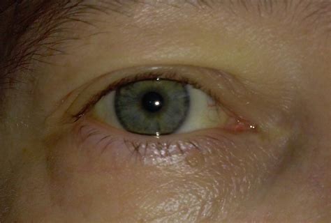 Causes Of Jaundice Eyes