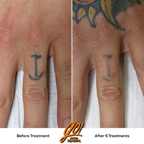 Fade Away Tattoo Cream: Does It Really Work? - Hunter Games Magazine