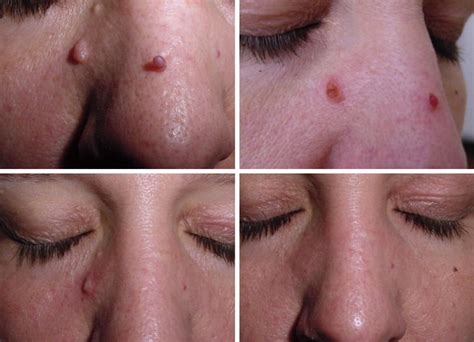 Cryopen Blemish Removal - Studio8beauty