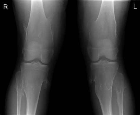 Multiple hereditary exostoses - Radiology at St. Vincent's University ...