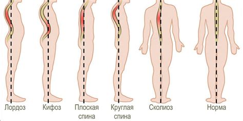 Виды искривления позвоночника: детальная классификация