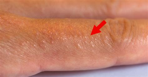 Itchy Bumps On Hands Treatment at Becky Uhl blog