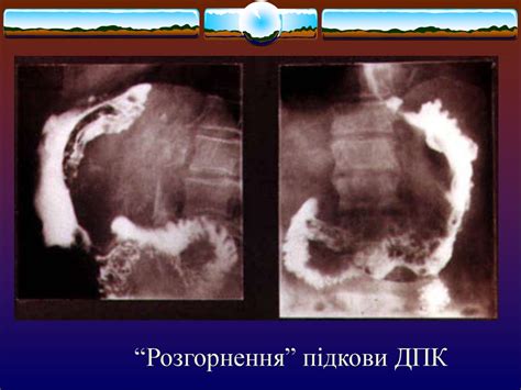 Хронічний панкреатит. Псевдокісти підшлункової залози - презентация онлайн