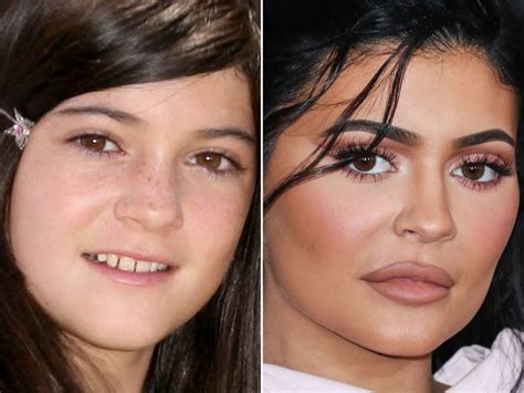 Kylie Jenner Before and After: From 2008 to 2022 - The Skincare Edit