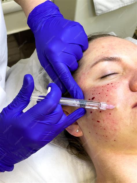 Premium Photo | Mesotherapy or biorevitalization procedure injection
