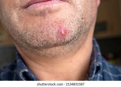 1+ Thousand Single Pimple Royalty-Free Images, Stock Photos & Pictures ...