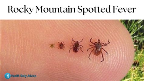 Rocky Mountain Spotted Fever: Symptoms, Causes, and Treatment