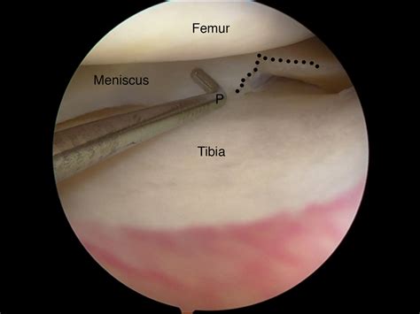 knee arthroscopy dr sunil reddy orthopaedics adelaide