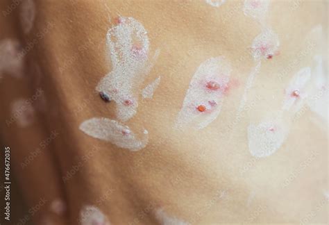 Chicken pox rash, chickenpox disease, Closeup.Consequences of chicken ...