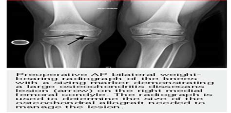 Fresh Osteochondral Allograft Transplantation for the Knee:... : JAAOS - Journal of the American ...