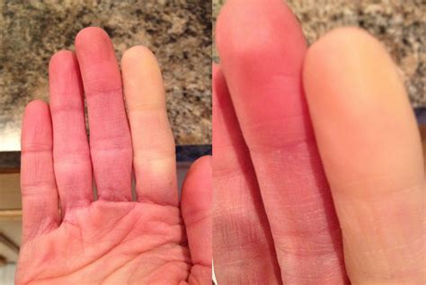 raynauds disease raynauds disease diseases club center