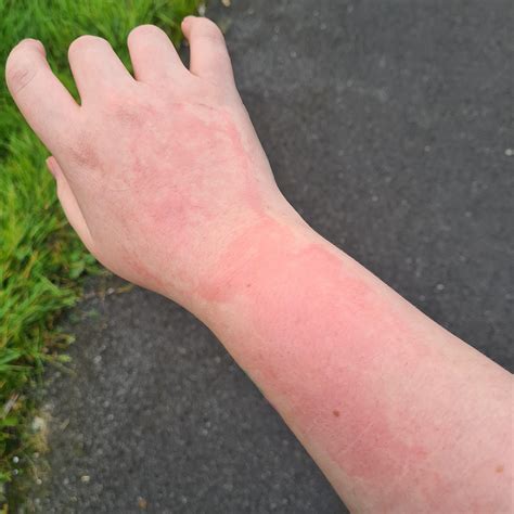 22 best r/allergy images on Pholder | My most recent environmental