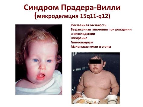 Синдром Прадера-Вилли | Справка.Неинвалид.ru