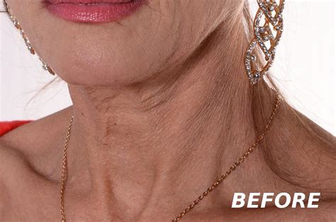 Nexsey Neck Tape for Sagging Wrinkly Skin Wrinkles or Double Chin Lift Lifting Tightening ...