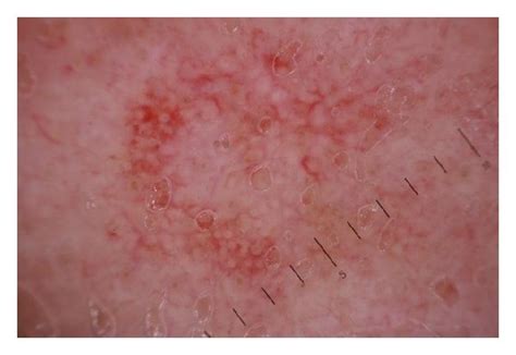 Dermoscopy of actinic keratosis versus lentigo maligna. (a) Actinic ...