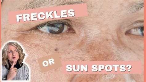What is the difference between freckles & sun spots (age spots)? How do ...