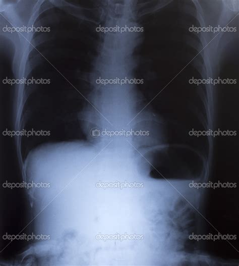 ray image  human chest   medical diagnosis stock photo