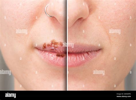 Closeup of a woman's lips before and after cold sores treatment, Herpes ...