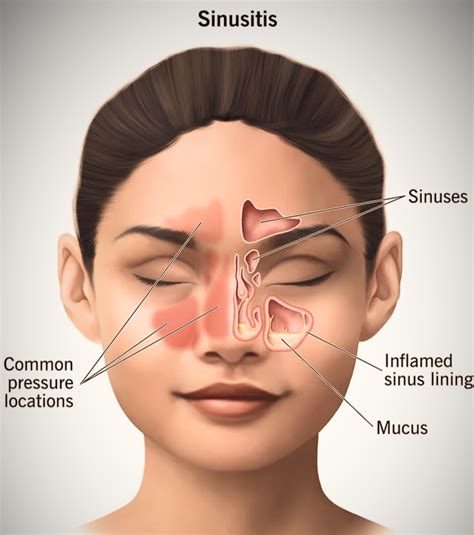 understanding sinusitis  symptoms  diagnosis