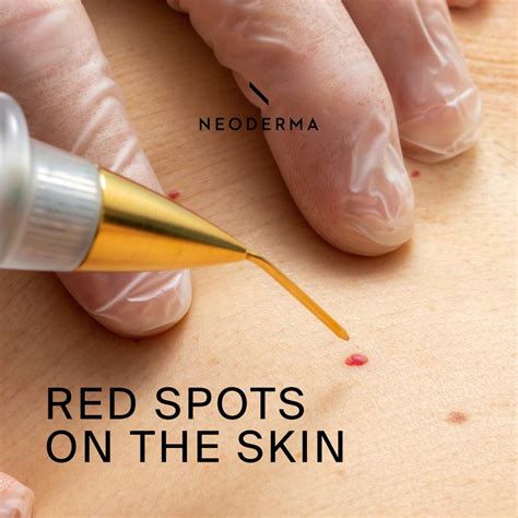 red spots   skin neoderma