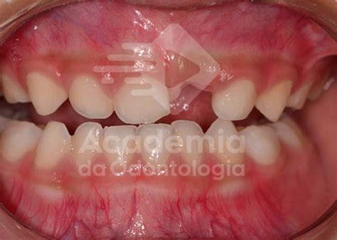 Tudo que você precisa saber para escolha do mantenedor de espaço