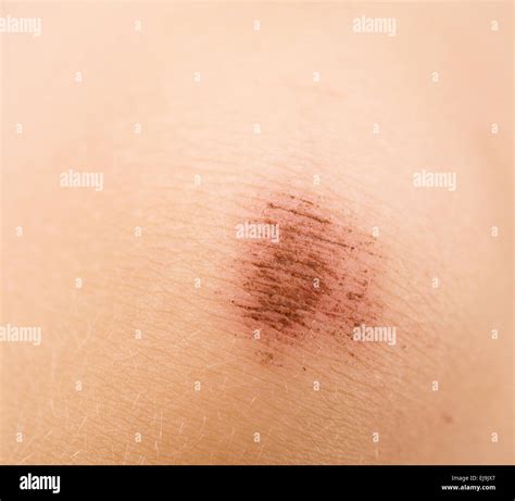 scraped knee Stock Photo - Alamy