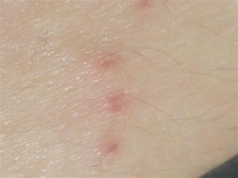 Scabies From Hotel Reddit at Ronald Lockett blog