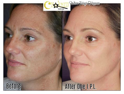 IPL – The Ultimate Way To Improve Sun Spots, Rosecea and Redness ...