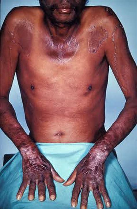 Pellagra - MEDizzy