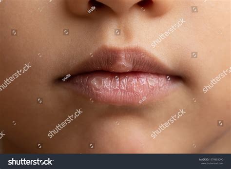 how to fix crusty lips