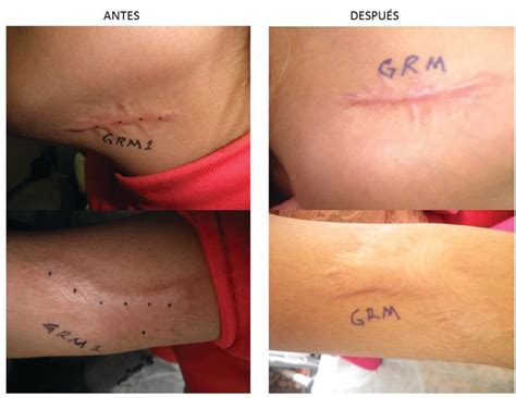 Cicatricure Antes E Depois Queloide - Uso de toxina botulínica en cicatriz queloide | Cirujano General